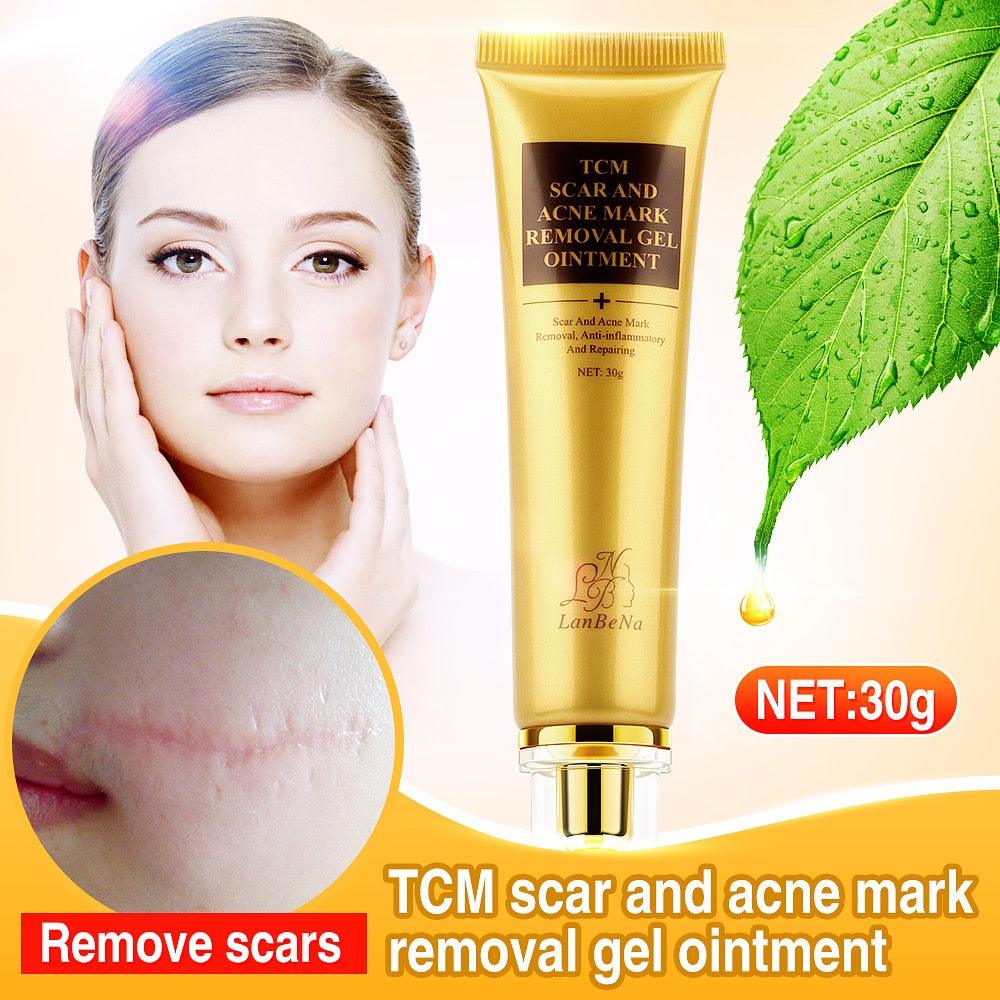 Stretch Marks Remove Acne Scar Treatment Cream Face Whitening Cream Pimple (M1)(1U86)