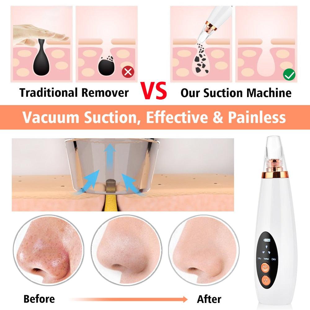 Electric Blackhead Remover Vacuum Suction Face Deep Pore Cleaner Pimple Acne Extractor (M5)(M1)(1U86)