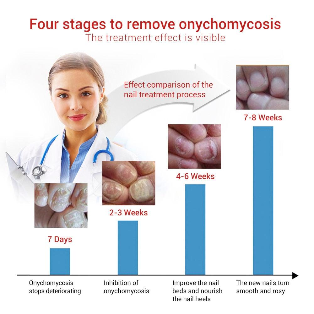 Nail Repair Essence Serum Care Treatment Foot Nail Fungus Removal Gel Anti Infection (N6)(1U85)