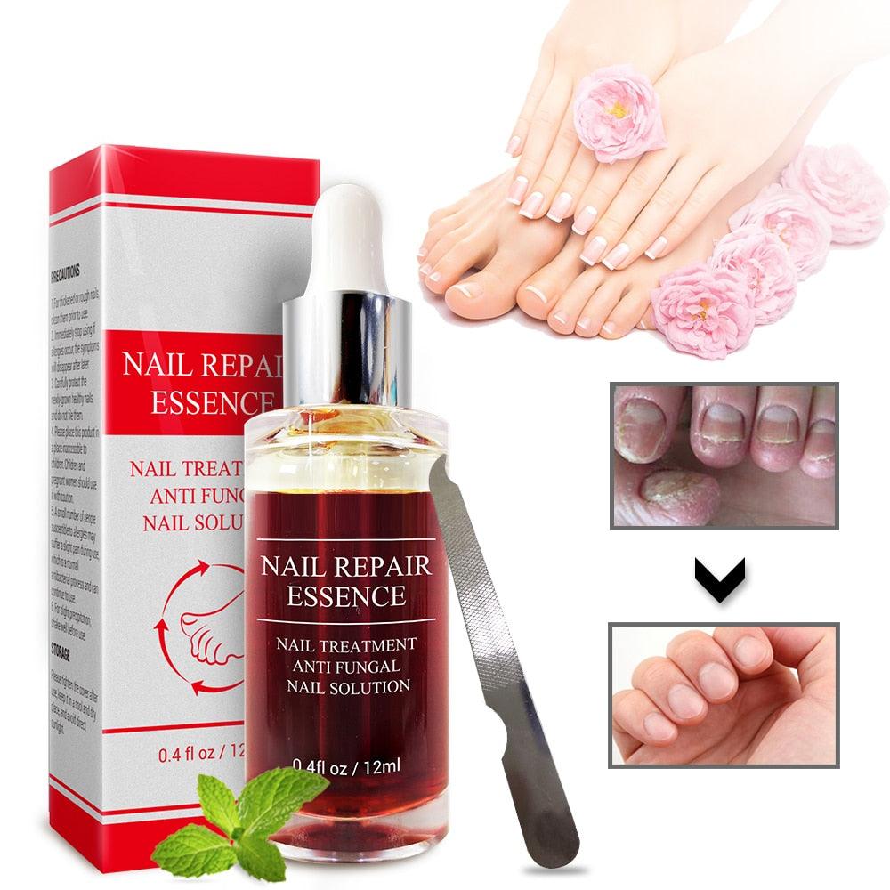 Nail Repair Essence Serum Care Treatment Foot Nail Fungus Removal Gel Anti Infection (N6)(1U85)