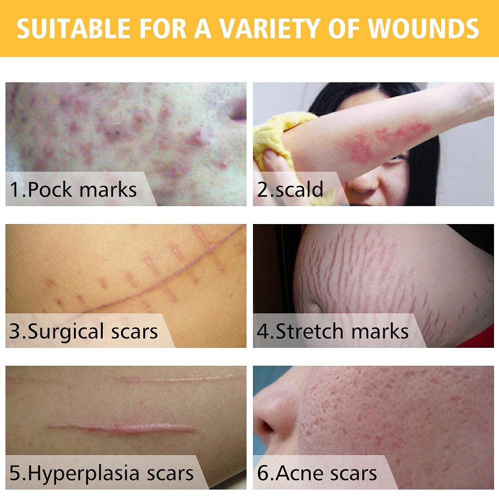 Acne Scar Removal Cream Skin Repair Face Cream Acne Spots Acne Treatment Blackhead 30ml (M1)(1U86)