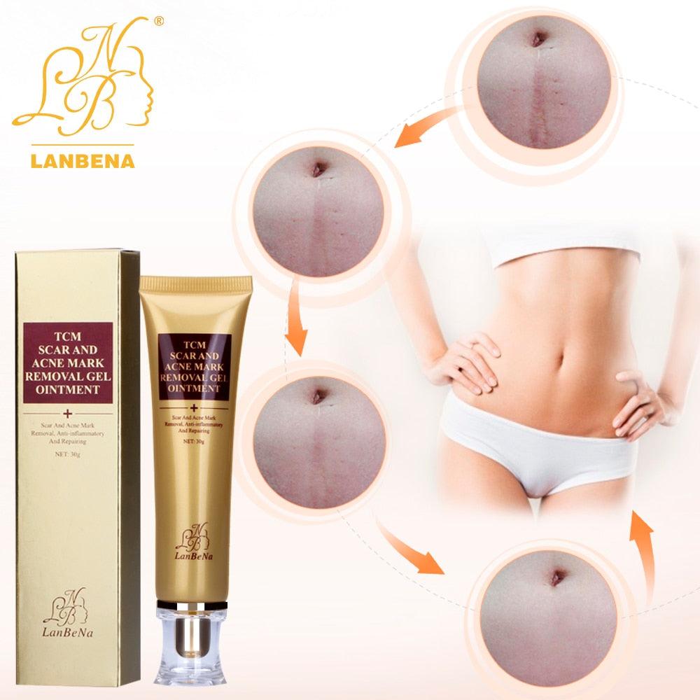 Acne Scar Removal Cream Skin Repair Face Cream Acne Spots Acne Treatment Blackhead 30ml (M1)(1U86)