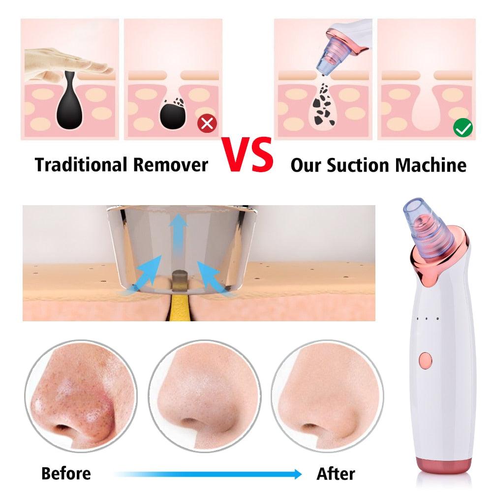 Facial Blackhead Remover Dead Skin Acne Pore Peeling Device Cleaning Skin Tool Vacuum Suck Out Blackhead (M5)(1U86)