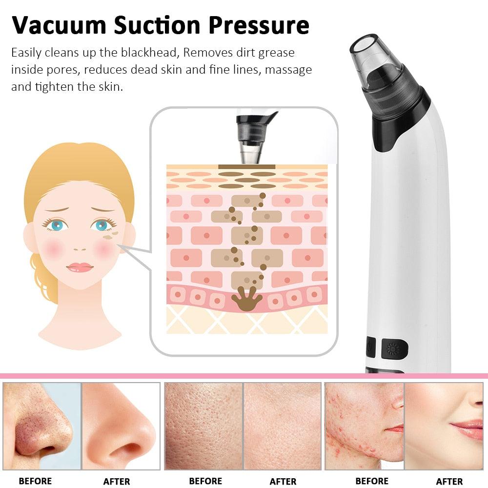 Facial Cleaner Nose Blackhead Remover Deep Pore Acne Pimple Removal Vacuum Suction Diamond T Zone (M5)(M1)(1U86)