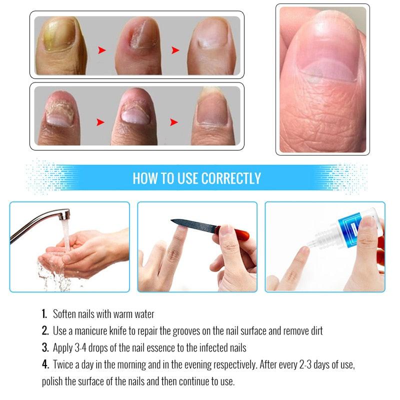 High Quality Nail Protector Skin Care ESSENCE Cream Nail Fungus Treatment Nails Repairing Cream Nail Care Tools (N6)(1U85)