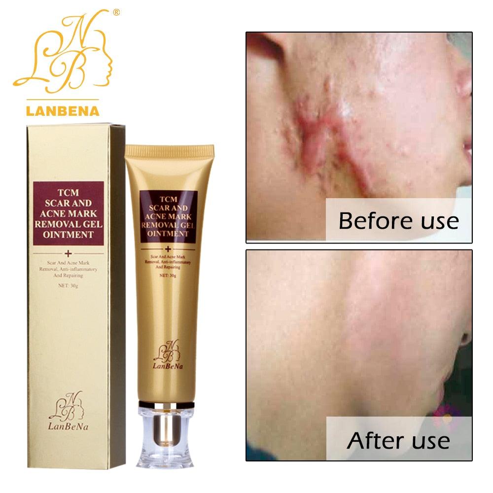 Acne Scar Removal Cream Skin Repair Face Cream Acne Spots Acne Treatment Blackhead 30ml (M1)(1U86)